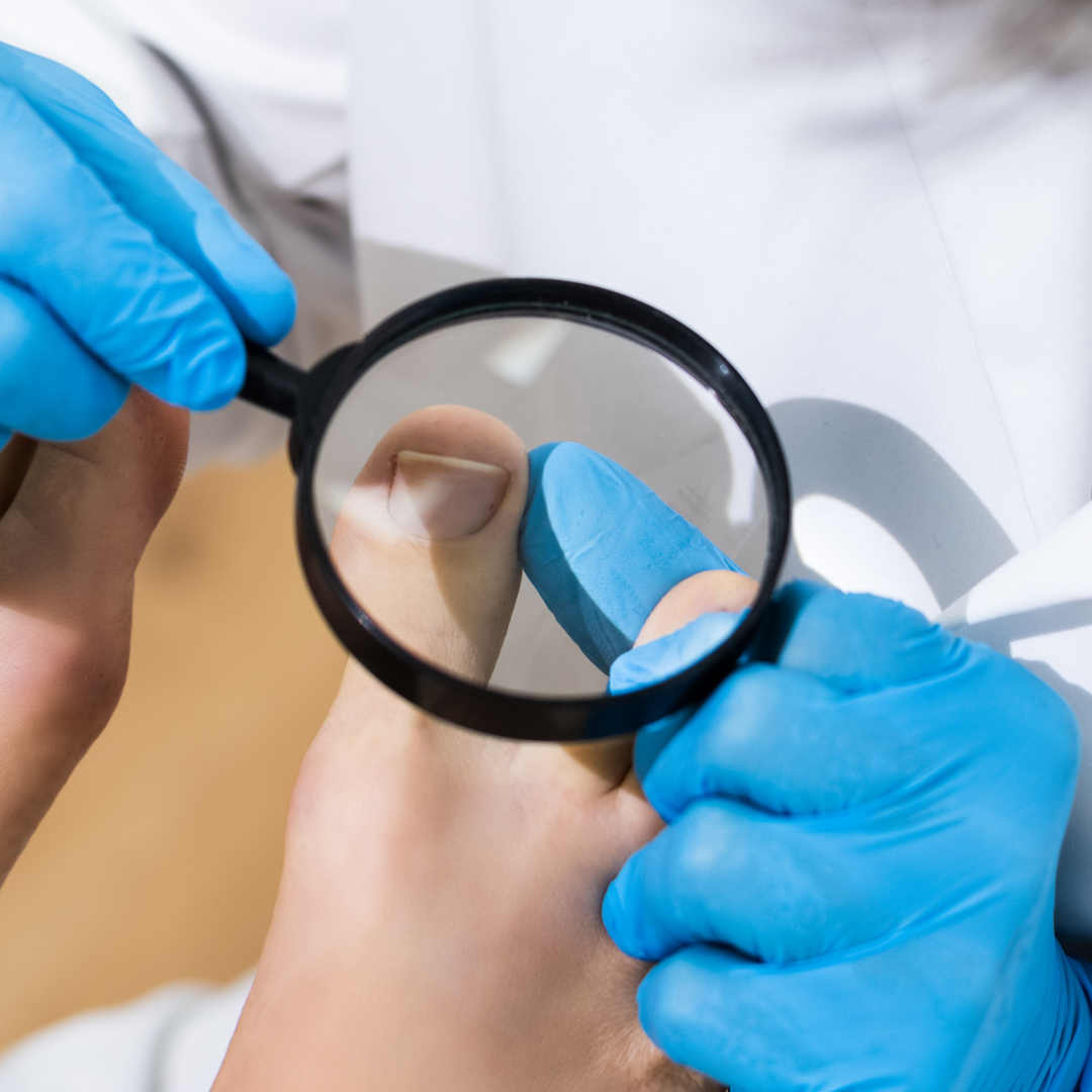 Tratamento para unha encravada