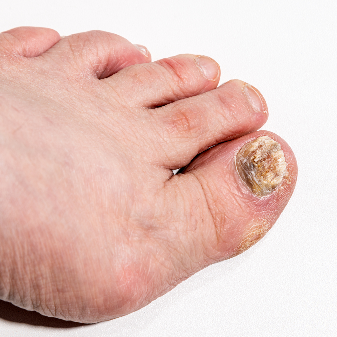 Tratamento para micose de unha