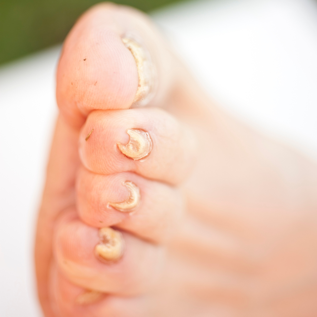 Tratamento para unhas deformadas